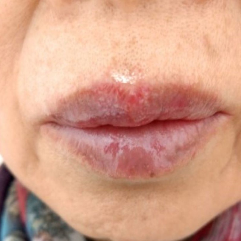 常發生在唇部的單純疱疹，水泡較為局限性。（照片提供／張郁琳）